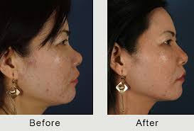 If you have a really long nose, for instance, and you want it to appear slim but smaller, you would put highlight on the tip of your nose, and contour the bridge and the tip with a darker shade to make the bridge look shorter. What Nose Issues Are Best Solved By Non Surgical Rhinoplasty Carolina Facial Plastics