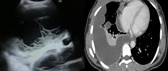 Rather than layering laterally and blunting of the costophrenic angle, the pleural fluid lies almost exclusively betw. Epos Trade