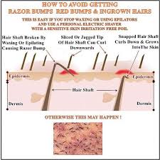 The Real Cause Of Ingrown Hairs And How To Avoid Getting Them Ingrown Hair Irritated Skin Prevent Ingrown Hairs