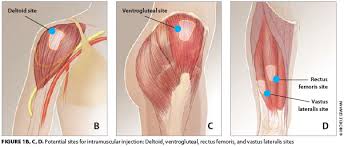 Find the acromion process, which is the bony point at the end of the shoulder. Large Volume Im Injections A Review Of Best Practices Oncology Nurse Advisor