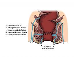 Image result for Intersphincteric Abscess