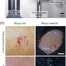 A shave biopsy site should heal without any scar. Size Comparison Of Needle Biopsy Devices And Biopsy Comparisons A Download Scientific Diagram