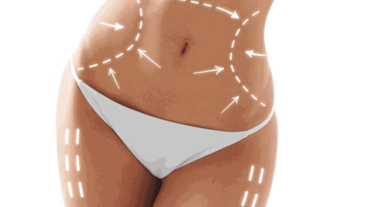 Abdominoplastie à Paris 16 | Chirurgie Esthétique | Avenue Foch