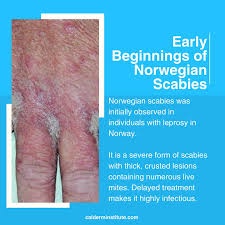 Image result for scabies norvegica