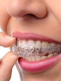 The retainer cost can be anywhere from $100 to $500 give or take a bit on either end. Retainers Orthodontist Ottawa On Centrepointe Orthodontics
