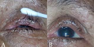 Image result for Entropion