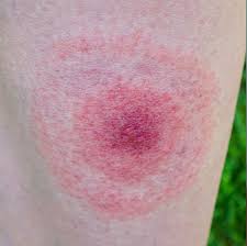 Image result for wolf spider bite skin