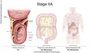 Stage 1a breast cancer means the following description applies: Colorectal Cancer Stages Cancer Net
