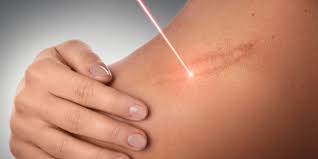 Yara Izi Skar Tedavisi Rene Clinic