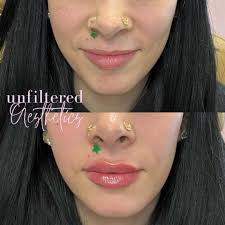 👄💉 Lip filler for a more balance and enhanced pout✨ Beautiful results in  the chair, even prettier in a week at the hands of Injector Jocelyn 🙌🏻 ✨M  A R C H