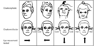 Image result for Oculovestibular Testing