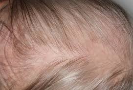 Myasthenia gravis is a chronic autoimmune, neuromuscular disease that causes weakness in the skeletal muscles that worsens after periods of activity and improves after periods of rest. Hair Disorders Finding The Root Of The Problem