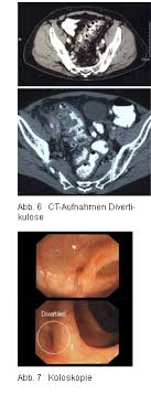„wenn zum beispiel eine starke blutung aus den divertikeln besteht, der darm an einer stelle perforiert ist und freie luft im bauchraum. Divertikulose Divertikulitis Symptome Behandlung Und Operation
