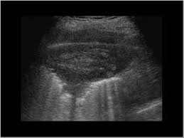 mesothelioma is contained to the main lung system in early stages. Thorax 8 2 Pleural Space Case 8 2 2 Benign And Malignant Pleural Thickening Ultrasound Cases