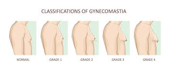 Image result for Gynecomastia