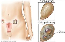 Pcos Cysts On Ovaries Make It Hard To Get Pregnant Ovarian Cyst Polycystic Ovary Syndrome Polycystic Ovaries