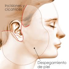 Resultado de imagen de cicatrices lifting frontal