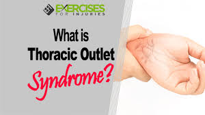 What Is Thoracic Outlet Syndrome Exercises For Injuries
