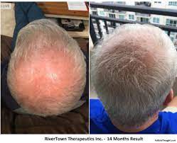 Updates Cures For Hair Loss 2021 Follicle Thought