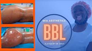 We would like to show you a description here but the site won’t allow us. Patient Journeys Plastic Surgery At Mia Aesthetics