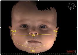 Aus der Universitätsklinik für Kinder- und Jugendmedizin Tübingen Abteilung  IV: Kinderheilkunde (Schwerpunkt: Neonatologie, n