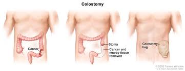 In fact, many of the symptoms of colorectal cancer can also be caused by other problems, such as infection, hemorrhoids, irritable bowel syndrome, or inflammatory bowel disease. Department Of Surgery Colon Cancer