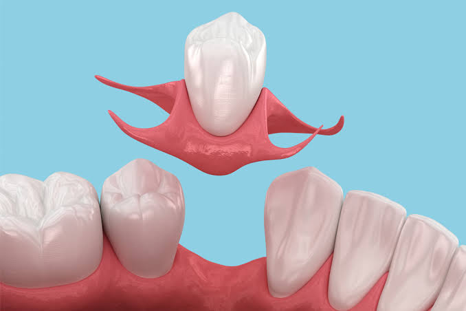 Best Options to Replace Missing Teeth (A Complete Guide)