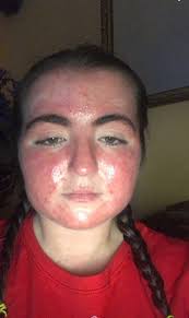 Bobert update 4-10-20. Still in ICU and