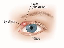 Check spelling or type a new query. Chalazion And Stye Eye Physicians Of Northampton