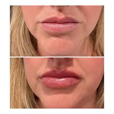 Nurse Injector Ashley