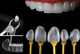 Benefits You Get with Non-Prep Crowns in Vietnam