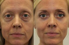 Buy under eye surgery 2026 Lower Eyelid Lift Eye Bag Removal Eye Bag  Surgery