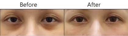 粹究美學 膠原蛋白熊貓針 黑眼圈微整 擺脫熊貓眼 讓妳的雙眼自然明亮動人 portfolio item portfolio clinic