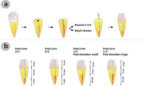 It has hue of 2.5y or yellower and normally has chroma of 6 or more, although chroma as low as 3 or 4 has been reported. Effect Of Fibre Post Length And Adhesive Strategy On Fracture Resistance Of Endodontically Treated Teeth After Fatigue Loading Dentistrykey