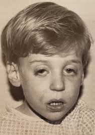 History of Phelan-McDermid Syndrome and Epidemiology