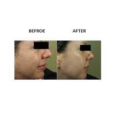 Does micropen help with uneven skin texture. Micropen Skin Rejuvenation Perfection Plastic Surgery Skin Care Tucson Az