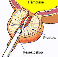 Gutartige Prostatavergrosserung Dr Med Robert Frese