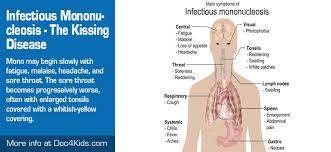 A healthcare provider will rub a cotton swab against the back of your throat. The Kissing Disease Infectious Mononucleosis Pediatric Affiliates Of Hampton Roads