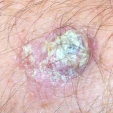 A series of mutations in the dna of the cell creates cancer. Squamous Cell Carcinoma Pictures Scc View Our Library