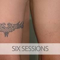 Maybe you would like to learn more about one of these? Eraditatt Tattoo Removal Of Orlando Central Business District Orlando Fl