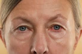Image result for Allergic Conjunctivitis