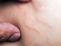 Stretch Marks On Thighs Appearance Causes And Treatments