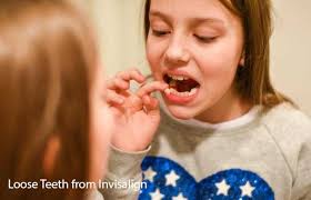 It is a temporary fix since composite bonding doesn't last very long. Why Loose Teeth From Invisalign Invisalign Support
