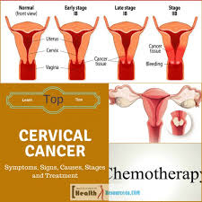 When cervical cancer is found early, it is highly treatable and associated with long survival and good quality of life. Cervical Cancer Symptoms Signs Causes Stages And Treatment