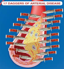 Misconceptions About Atherosclerosis Preventative Health Cholesterol Heart Attack Symptoms