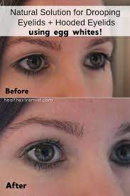Top 4 exercise to tighten droopy eyelids wrinkle around eyes ihealthiness. Natural Remedy For Drooping Eyelids Sagging Eyelids Or Hooded Eyes