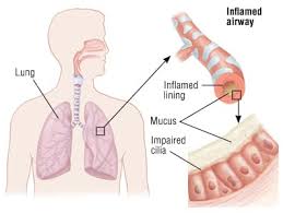 Image result for Acute Bronchitis