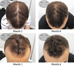 While women also struggle with thinning hair and hair loss, men outnumber women in this category: Hair Growth Success After I Ve Followed The Treatment I Improved A Lot
