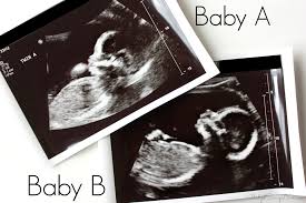 Check out hundreds of amazing twin ultrasound images! 20 Weeks Ultrasound Update Twins Budget Savvy Diva