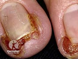 Image result for paronychium